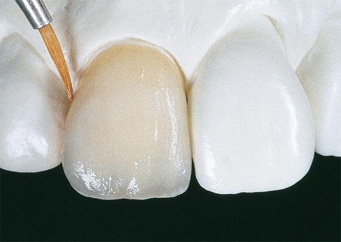 Dentalkeramik bemalen